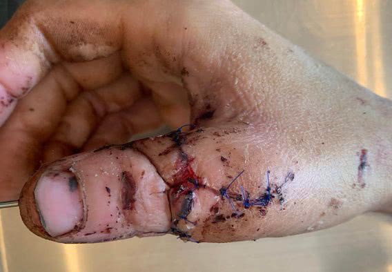 Хирурги Николаевской больницы №4 пришили палец, изуродованный другими врачами