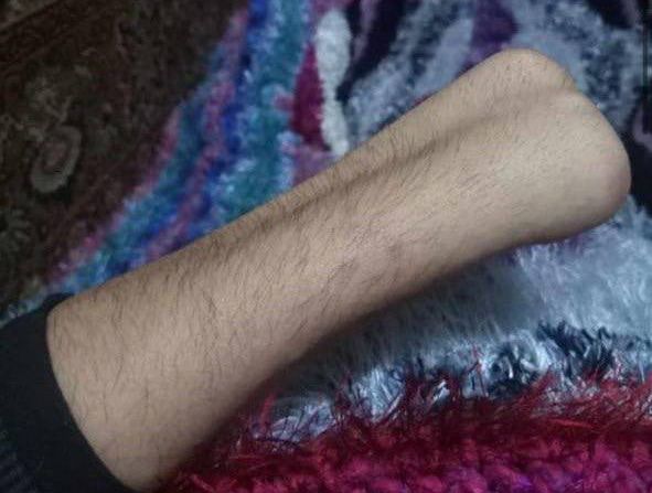 Скандал с "мобилизацией" безрукого инвалида. Что произошло на самом деле