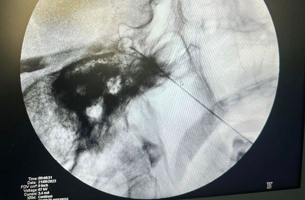 Двух пациентов Николаевской БСМП в результате 30-минутных операций избавили от многолетних болей