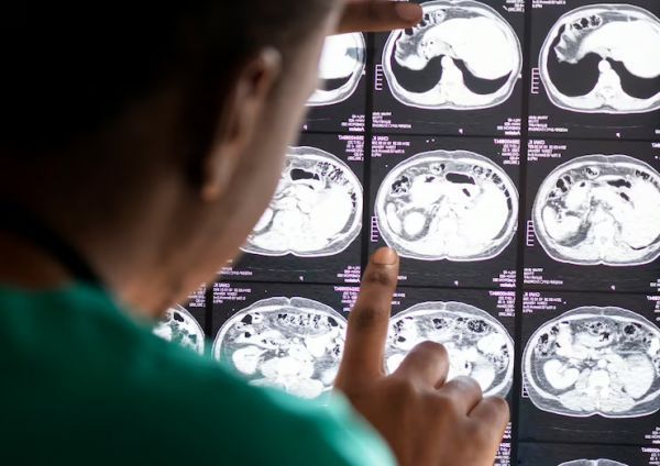 С начала года в Николаеве вернули к нормальной жизни 95 пациентам, у которых случился инсульт