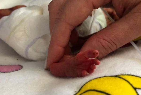 В Николаеве выхаживают малыша, родившегося с весом 750 грамм