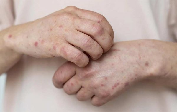 В Николаеве семья заболела корью, а ребенок с осложнением после ветрянки попал в реанимацию