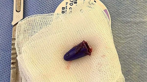 Во Львове школьница проглотила колпачок от ручки: ей пришлось провести открытую операцию