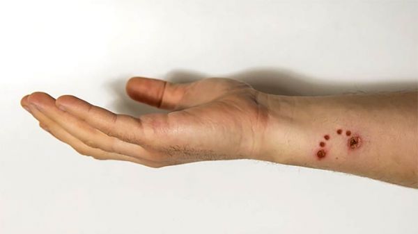 В Николаевской области нет препаратов против бешенства