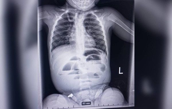 Врачи прооперировали ребенка, который проглотил гидрогелевый шарик