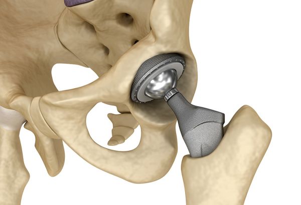 Бесплатные суставы для николаевцев: в 2025 году город закупил 80 эндопротезов